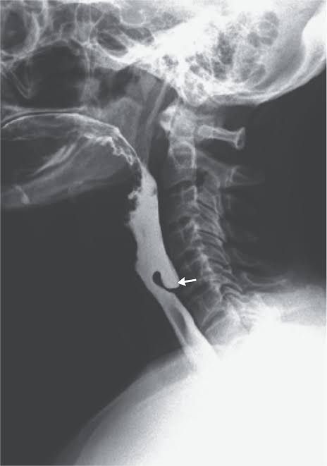 51-year-old Iraqi man treated for rare eating & swallowing disorder 51-year-old Iraqi man treated for rare eating & swallowing disorder
