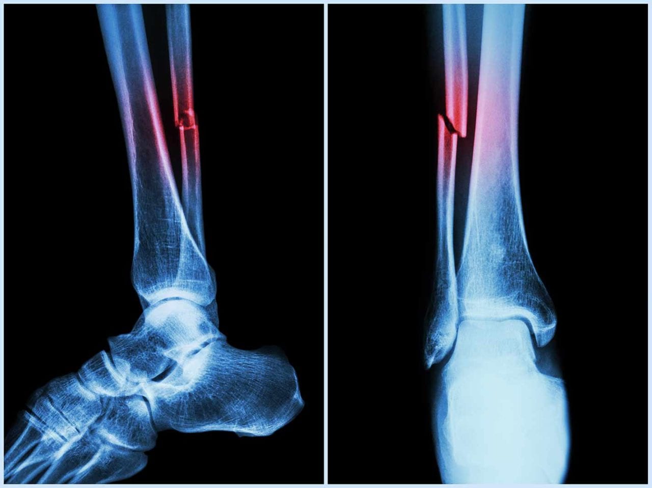 Covid can cause bone loss, higher fracture risk: Study