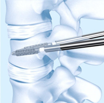 65-year-old woman undergoes vertebral body stenting in Hyderabad 65-year-old woman undergoes vertebral body stenting in Hyderabad
