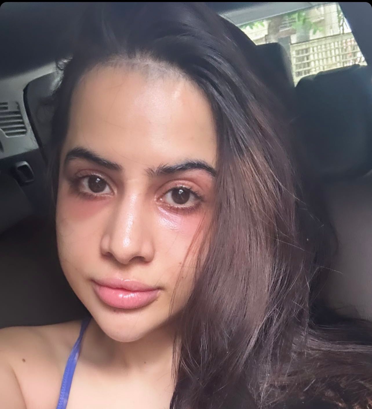 Uorfi’s under-eye fillers go wrong: ‘Why did I do this to myself?’