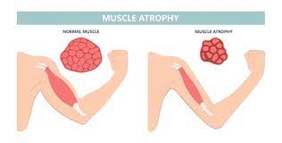 Cancer patients: Maintaining muscle is important, staying strong is complicated